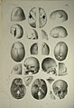 Chirurgischer Atlas der chirurgischen Krankheiten von Dr. Victor Bruns, 1853 (12)-2.jpg