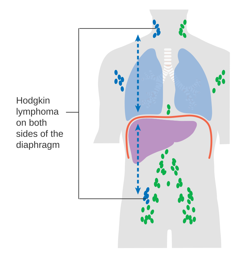 Diagram showing stage 3 Hodgkin's lymphoma CRUK 221.svg