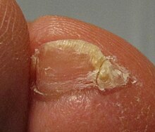 Accessory nail of the fifth toe - Wikipedia