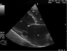 Labeled chambers Dilated cardiomyopathy B-Mode.jpg