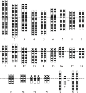 Down Syndrome Karyotype.png