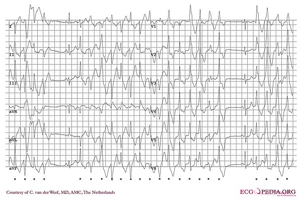 polymorphic ventricular tachycardia ecg