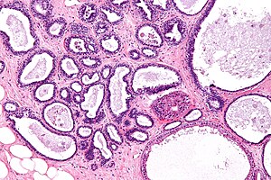 Fibrocystic change - intermed mag.jpg