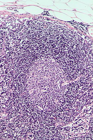 Follicular lymphatic hyperplasia, HE.jpg