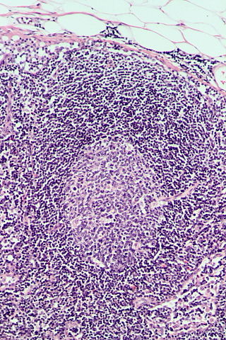<span class="mw-page-title-main">Follicular hyperplasia</span> Medical condition of lymphatic cells
