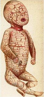 Harlequin-type_ichthyosis