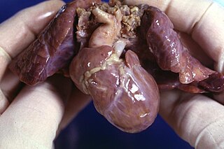 <span class="mw-page-title-main">Hypoplastic right heart syndrome</span> Type of congenital heart disease