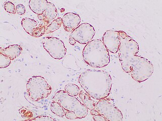 Immunohistochemistry for calponin in ductal carcinoma in situ, highlighting myoepithelial cells around all tumor cells, thereby ruling out invasive ductal carcinoma.