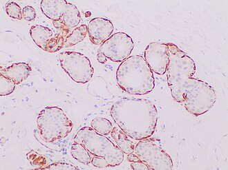 Immunohistochemistry for calponin in ductal carcinoma in situ, highlighting myoepithelial cells around all tumor cells, thereby ruling out invasive ductal carcinoma. Immunohistochemistry with calponin in ductal carcinoma in situ.jpg