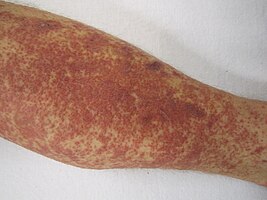 Leukocytoclastic vasculitis