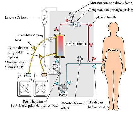 Fail:Mekanisma hemodialisis.jpg