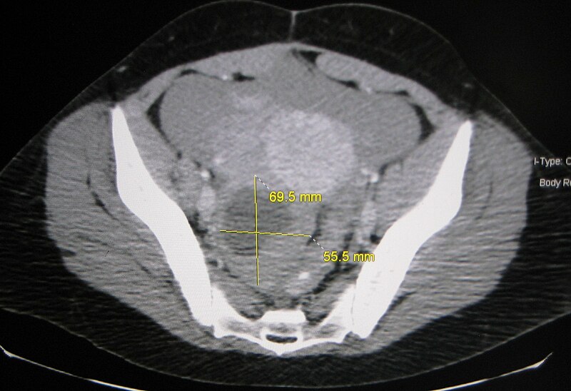File:Ovarian Cyst.JPG