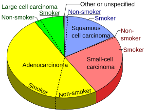 Pie chart of lung cancers.svg