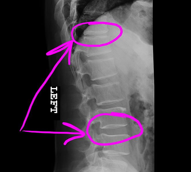 File:Pointmaker Annotation of Digital XRay.jpg