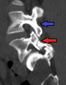Anterolisthesis L5/S1. Blue arrow normal pars interarticularis. Red arrow is a break in pars interarticularis.