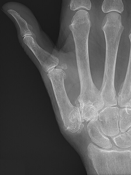 File:Trapeziometacarpal osteoarthritis with subluxation.jpg