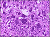 Tumor giant cell.jpg