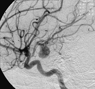 Aneurysm bulge in the wall of a blood vessel