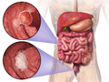 Thumbnail for Colorectal cancer