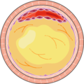 Atheroma 13