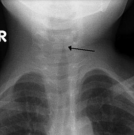 Croup steeple sign.jpg