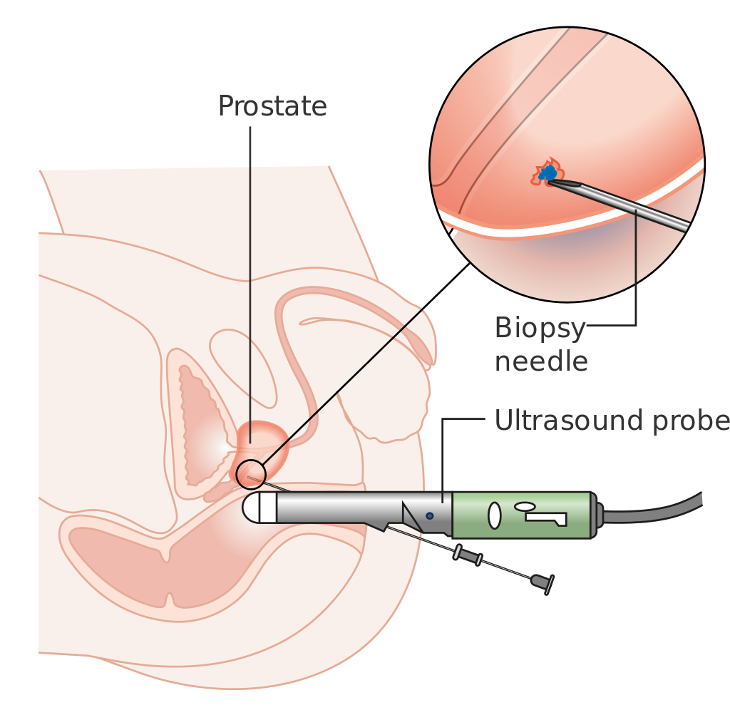 Diagram showing a prostate biopsy CRUK 472.svg