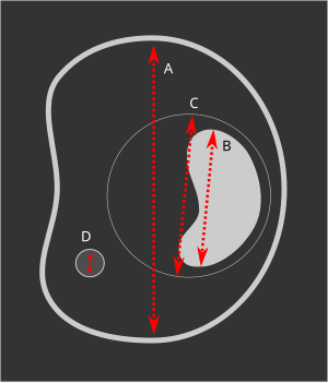 Gestational sac.svg