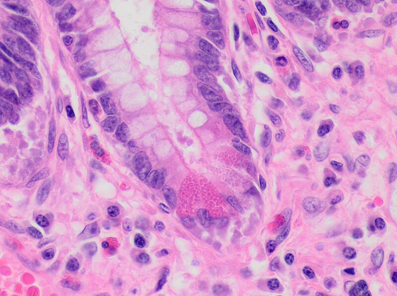 File:Histopathology Paneth cell metaplasia.jpg