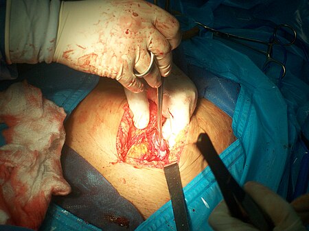 การผ่าตัดทำหมันหญิง