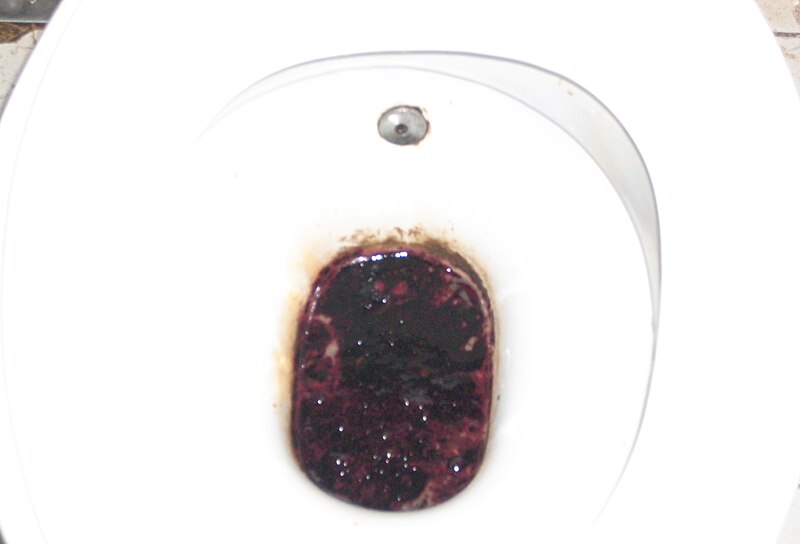 File:Melena Bleeding DU.jpg