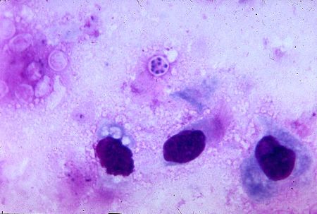 Tập_tin:Pneumocystis_carinii_PHIL_2998_lores.jpg