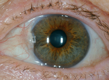 Small pterygium Pterygium.png