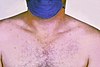 腸チフス患者。この患者は胸の部分にピンク色の発しんが確認されている