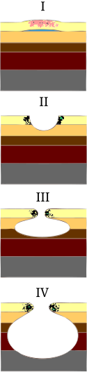 Stages I to IV of a pressure ulcer Schema stades escarres.svg