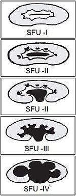 Society for Fetal Urology (SFU) grading of hydronephrosis.jpg