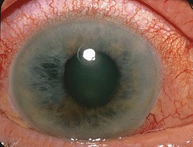 Вид глаза при глаукоме