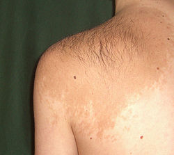 Becker's nevus on left shoulder & back