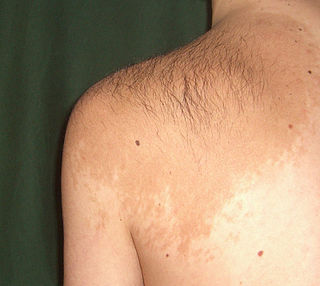 <span class="mw-page-title-main">Becker's nevus</span> Medical condition