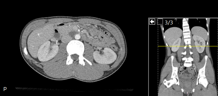 CT of a normal abdomen and pelvis, axial plane 115.png