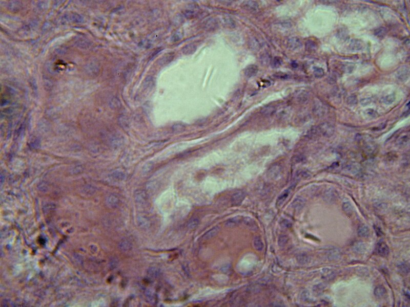 File:Chronic Nephritis2.jpg