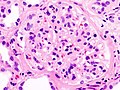 नेफ्रोटिक सिंड्रोम के साथ मधुमेही ग्लोमेरुलोस्केलेरोसिस की हिस्ट्रोपैथोलॉजीकल छवि.अन्य ग्लोमेरूलास. एच एंड ई धब्बा.
