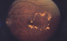 is macular oedema the same as macular degeneration