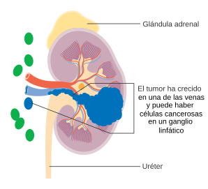 Cáncer de riñón