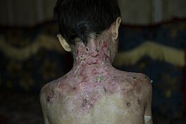 Epidermolysis bullosa in Iran- Kerman province & Balochistan - Photo by Mustafa Meraji- Wikipedia free photos 10.jpg