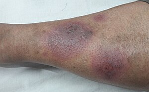 Erythema Nodosum