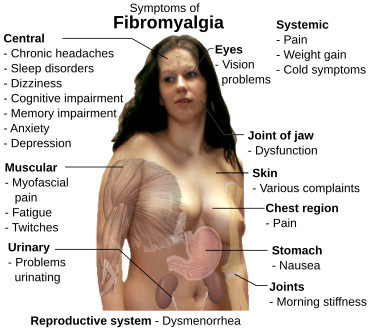 Fibromiyalgiya symptom.svg