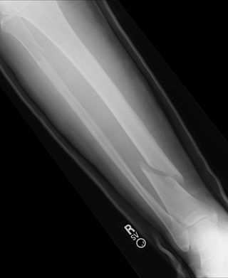 Fractured TIBIA FIBULA 01-15 1.jpg