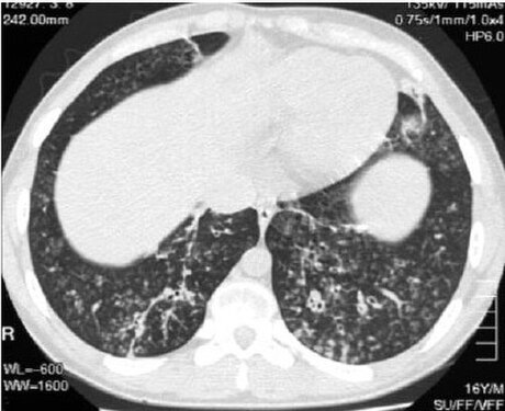 Panbronchiolite diffusa