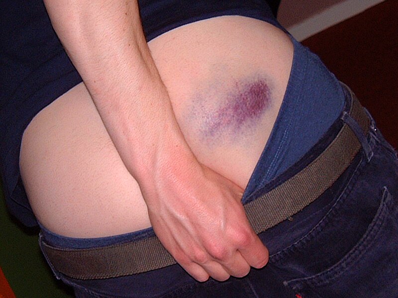 File:Hematoma at backside.jpg