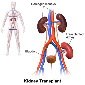 Buyrak Transplantatsiyasi